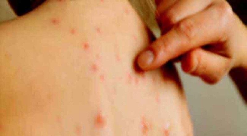 தட்டமைக்கான விசேட தடுப்பூசி வேலைத்திட்டம் இன்று முதல் ஆரம்பம்!