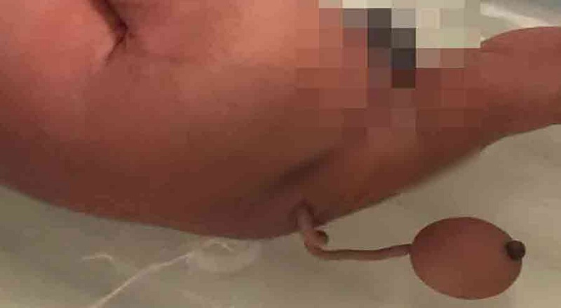 வாலுடன் பிறந்த குழந்தை