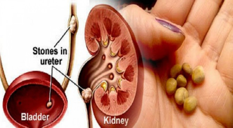 சிறுநீரகக் கல் வராது தடுக்கவல்ல உணவு வகைகள்.