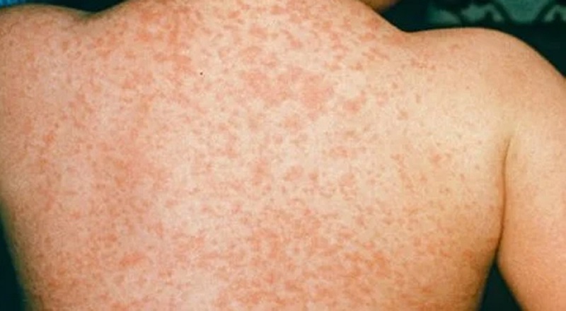 குழந்தைகள் மத்தியில் தட்டம்மை நோய் அதிகரிப்பு