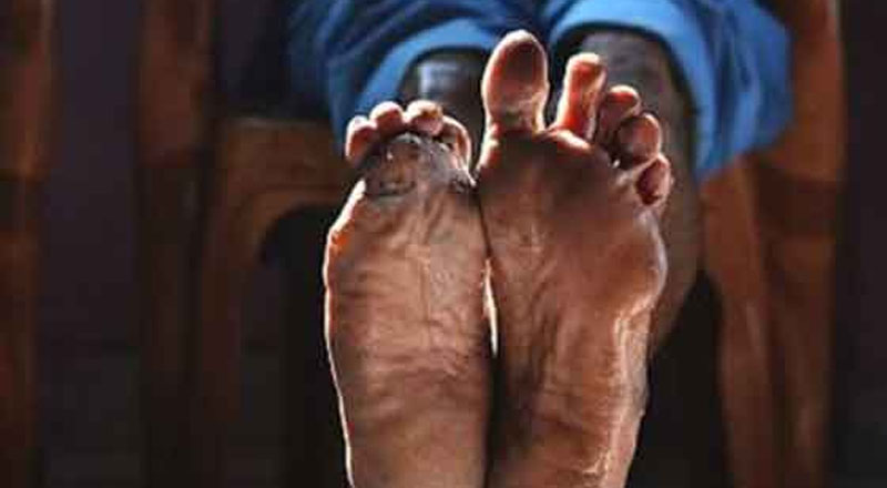 குழந்தைகள் மத்தியில் பரவும் புதிய நோய்!